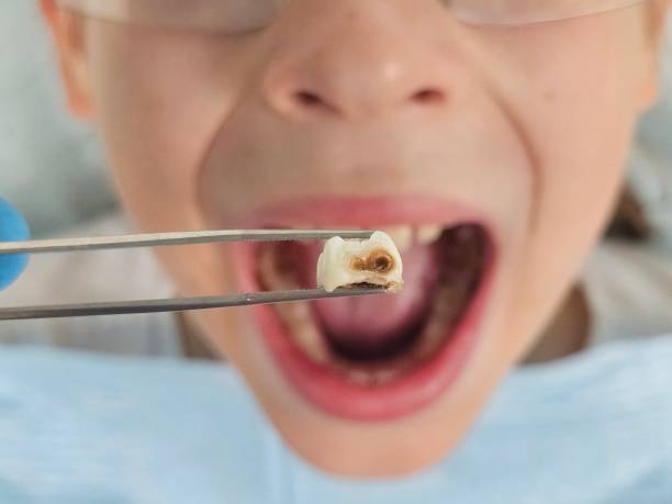 Best Pediatric Emergency Dentist in Pilot Point, TX